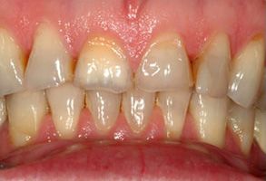 Berchelmann Family Dental | Dental Bridges, Ceramic Crowns and Dentures